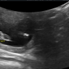 Foot on Ultrasound